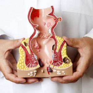 هموروئید یا بواسیر